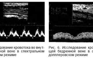 Магистрально измененный тип кровотока. Патология сосудов головы и шеи на уздг (лекция на диагностере)