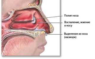 Большие лобные пазухи. Симптомы и лечение воспаления лобных пазух