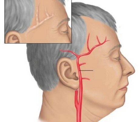 Болит голова в виске с левой стороны и отдает в глаз
