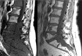 Шишка на спине начала болеть