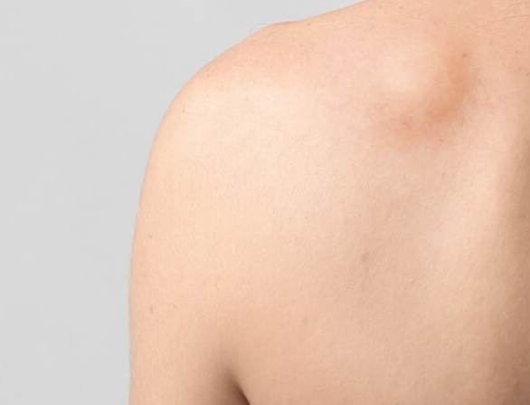 Болит жировик на спине