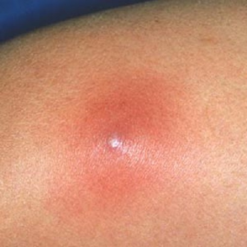 Жировик покраснел и болит