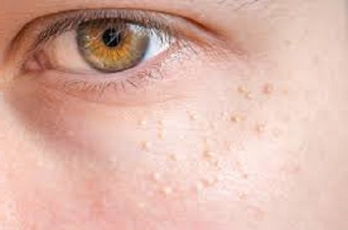 Почему болит жировик?