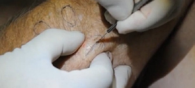 Удаление жировика хирургическим путем