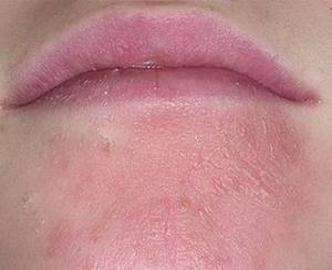 Красные припухшие пятна на теле