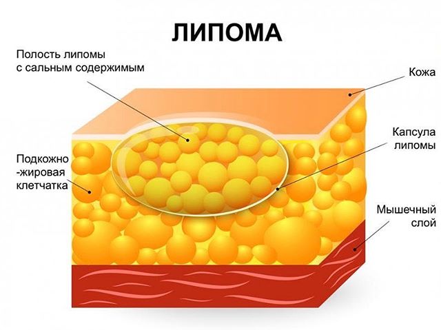 Шишка на спине начала болеть