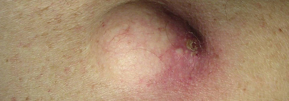 Шишка на спине начала болеть