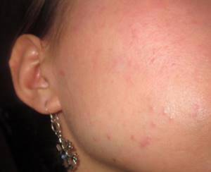 Красные припухшие пятна на теле