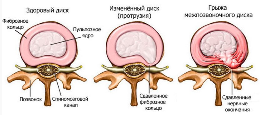 Образование межпозвоночной грыжи Стадии образования межпозвоночной грыжи