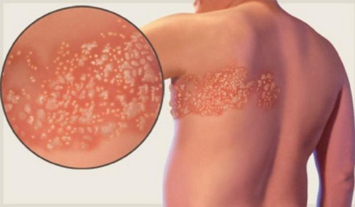 Болит спина у лопаток утром