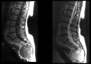 Шишка на спине начала болеть