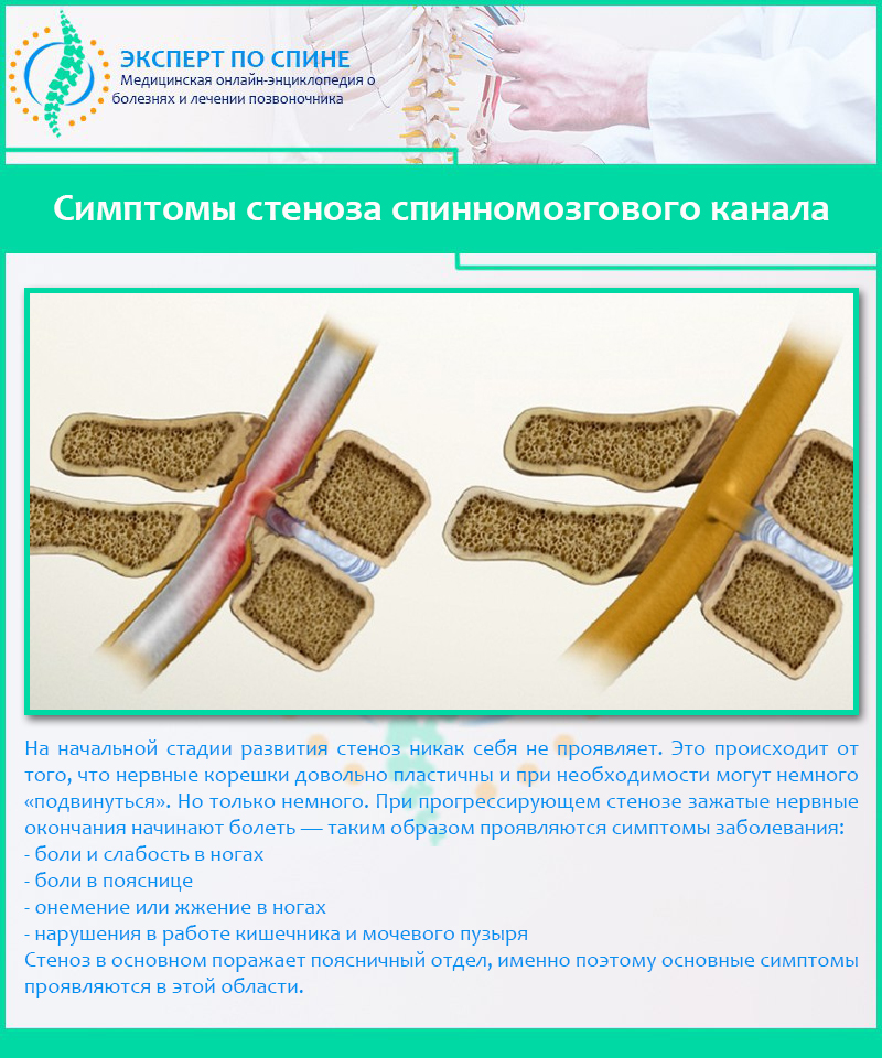 Симптомы стеноза спинномозгового канала