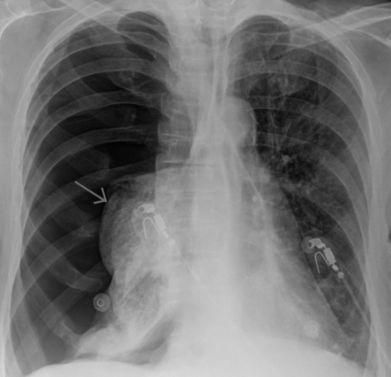 Что может болеть справа в боку и отдавать в спину