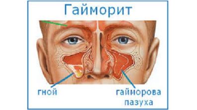 У меня болит спина и температура
