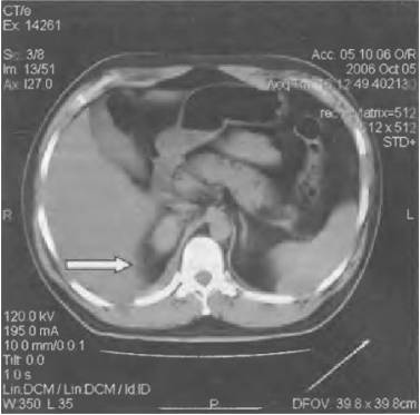 Что может болеть справа в боку и отдавать в спину