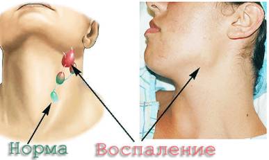 У меня болит спина и температура