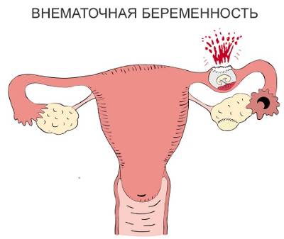 В середине цикла болит низ спины что это