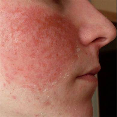 Красные припухшие пятна на теле