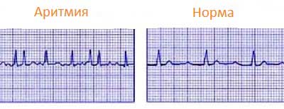 проявление аритмии на ЭКГ