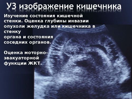 УЗИ кишечника