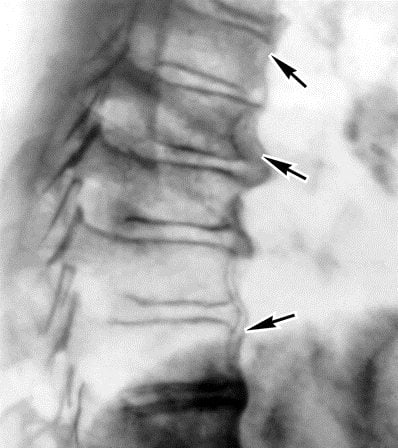 Болит позвоночник в середине спины