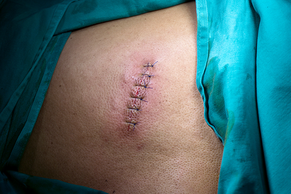 Шишка на спине начала болеть