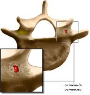 Шишка на спине начала болеть