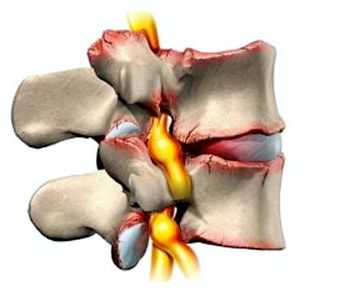 Болят ребра на спине тяжело дышать
