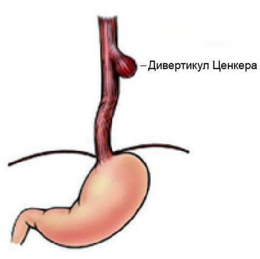 Дивертикул Ценкера Дивертикул Ценкера
