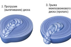 если болит спина после прыжка